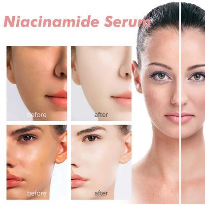 Suero de niacinamida Corrector de manchas oscuras Hidratante Iluminador Atenúa líneas finas Limpieza profunda Desmaquillante Cuidado de la piel coreano